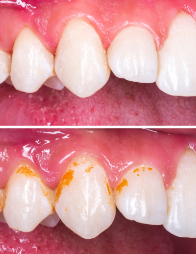 Teeth
